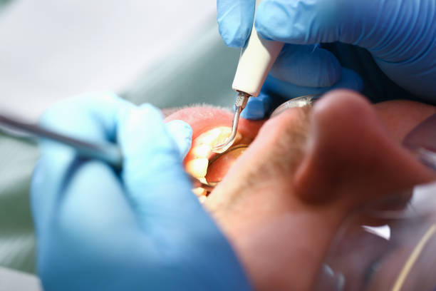 Best Broken or Cracked Tooth Emergency Dentist in Parkersburg, WV